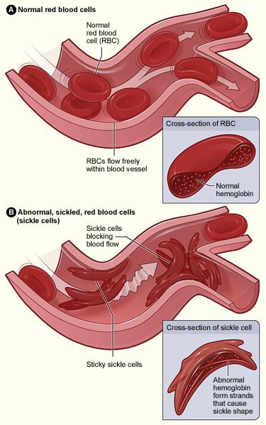 Sickle Cell