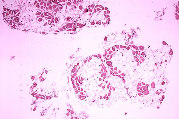 Duchenne Muscular Dystrophy