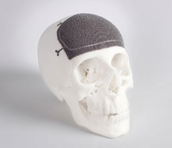 Skull with a 3D-printed implant.