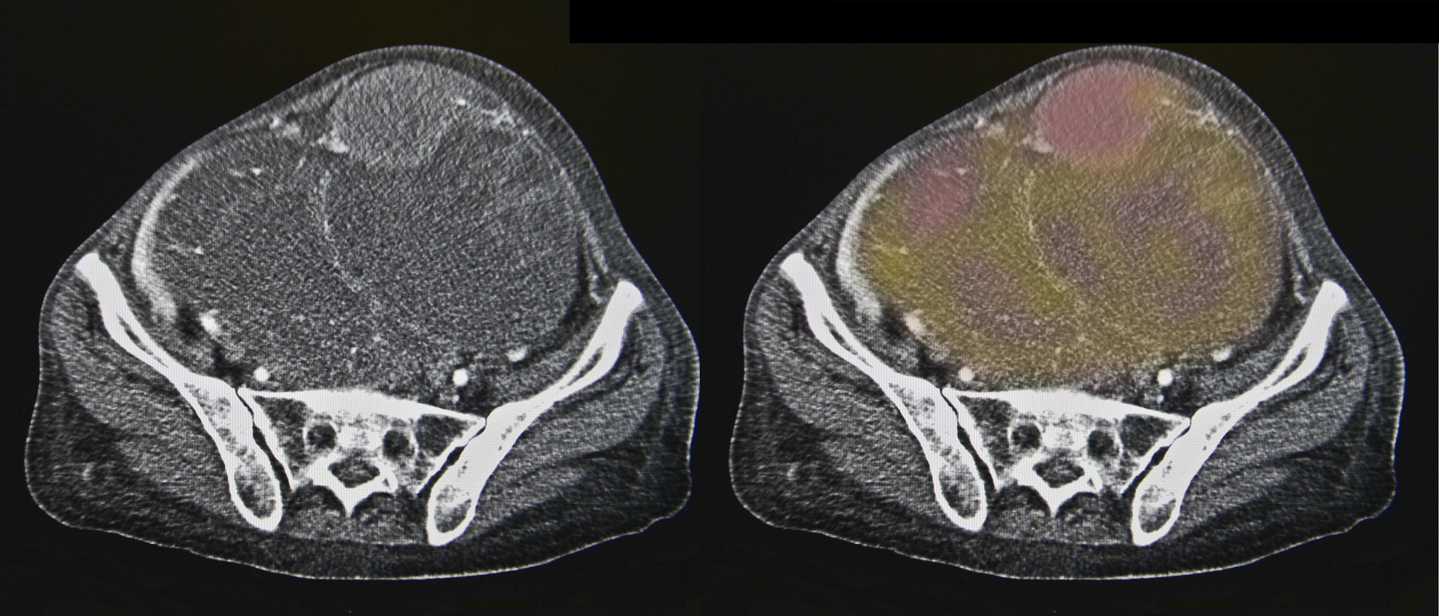 CT scan of ovarian cancer