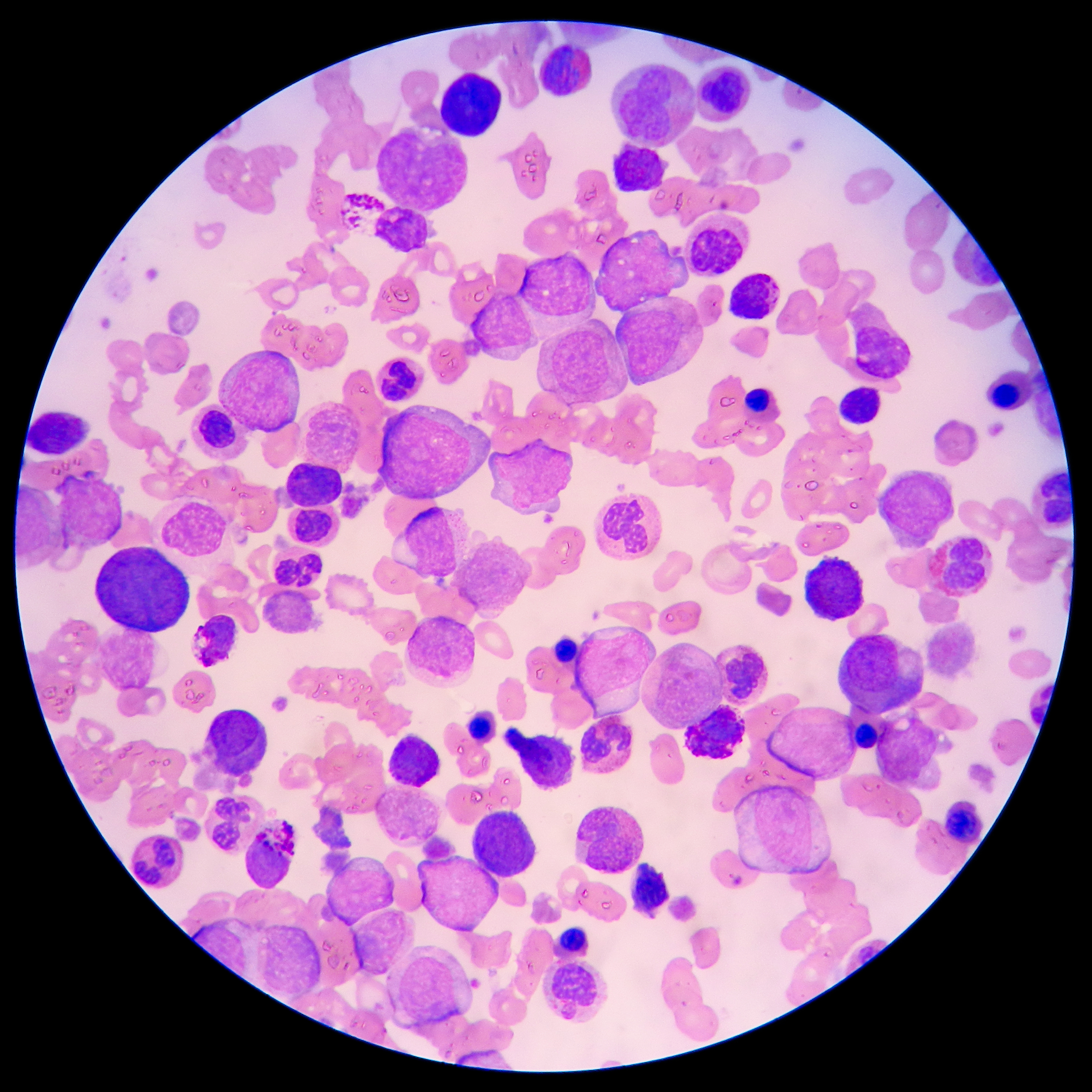 Blood smear from a leukemia patient under a microscope