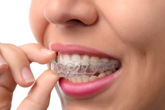 Woman inserting a silicone dental aligner
