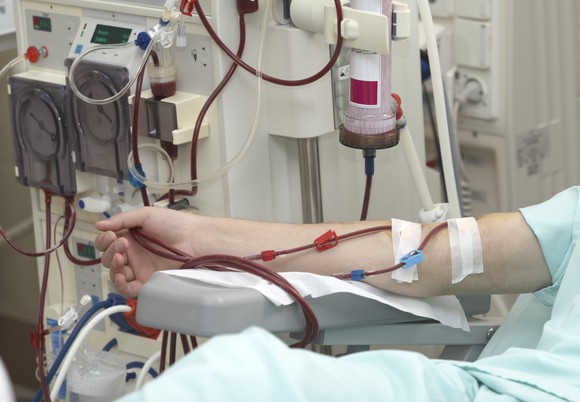 Patient's arm hooked up to a dialysis machine.