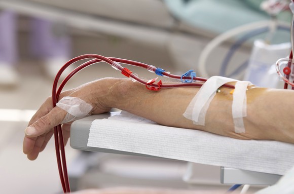 Patient's arm hooked up to dialysis