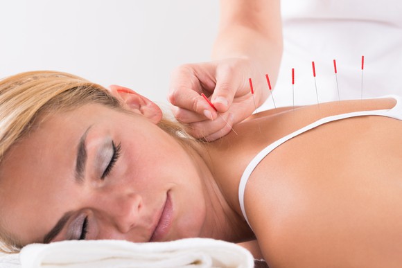Woman lying down with person sticking acupuncture needles in her back