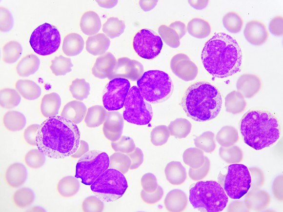 Purple-stained leukemia cells viewed under a microscope
