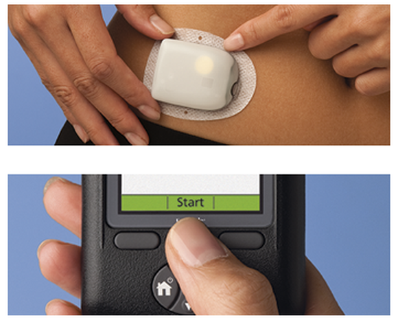 Two-panel image: Uppers shows an Omnipod on a woman's stomach and lower shows the control device in a woman's hand.