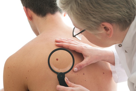 Doctor looking at a spot on patient's back with a magnifying glass