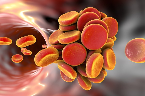 A thromboembolism in the bloodstream.