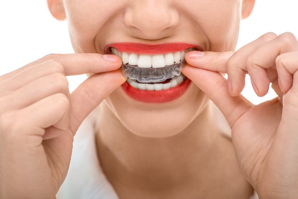 A smiling woman placing a clear silicone aligner on her upper teeth.