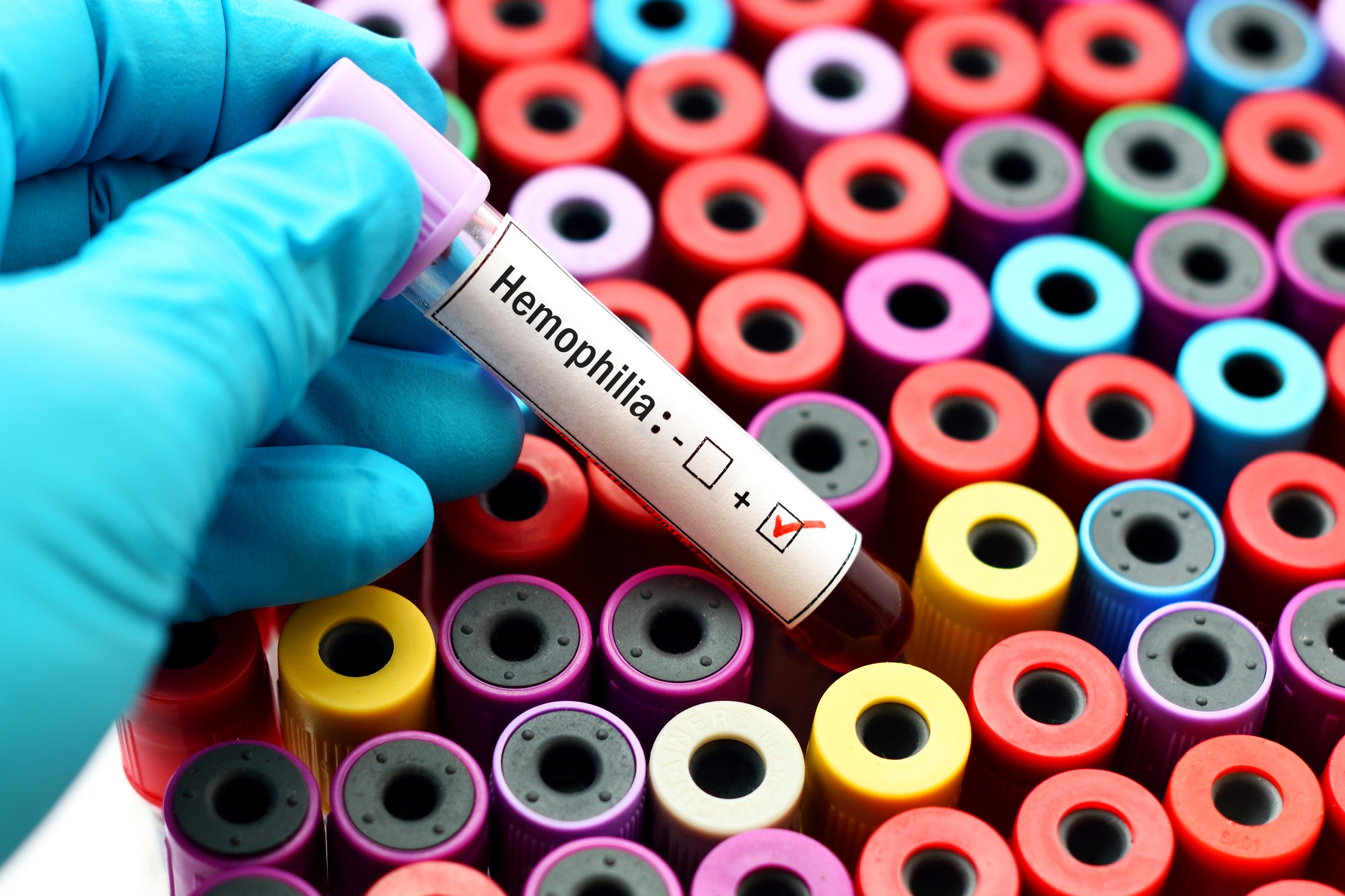 A person picking one of many blood vials, with this particular one being positive for hemophilia.