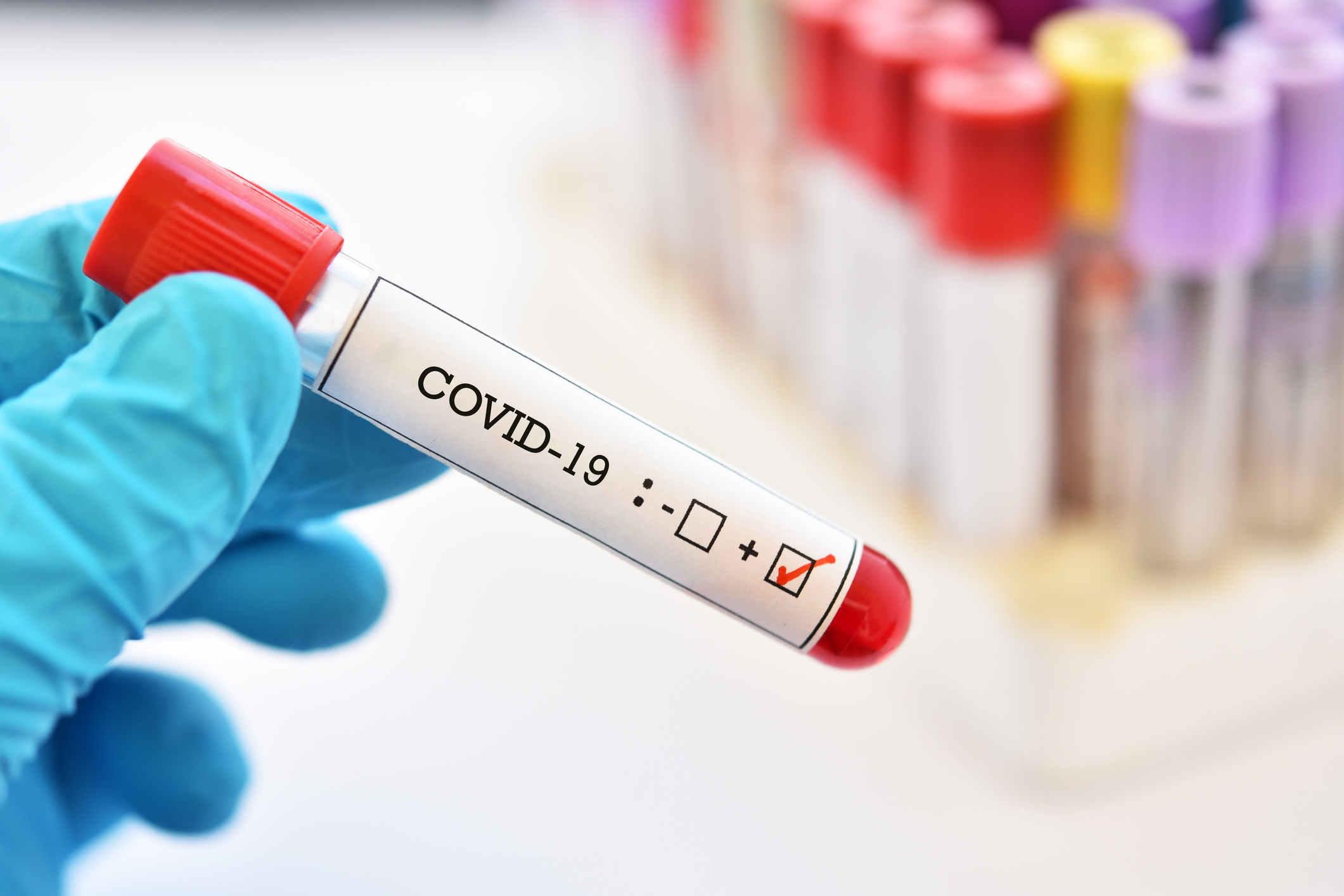 A COVID-19 positive blood sample.