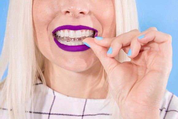 A woman putting on clear dental aligners.