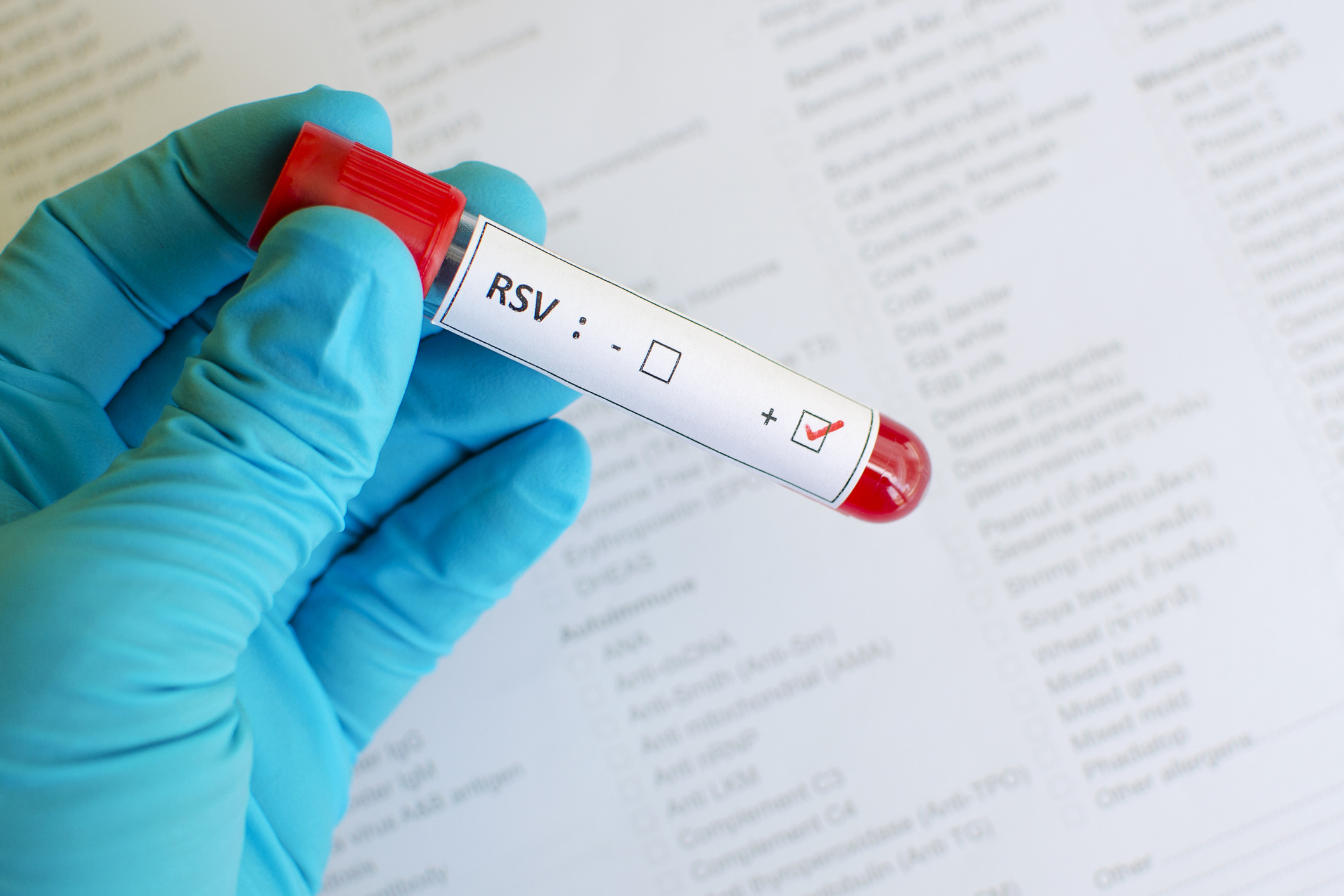 A blood sample in a test tube that tests positive for respiratory syncytial virus.