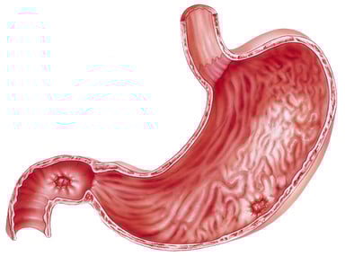 Gastric ulcers