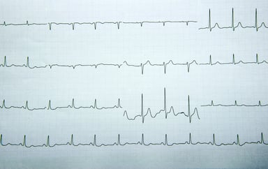 EKG