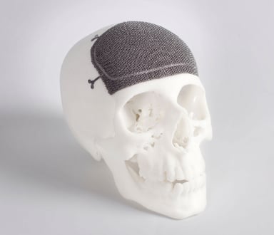 arcam implant skull cropped so horiz