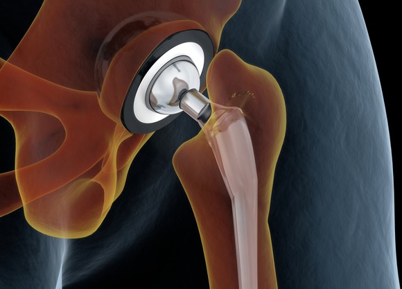 Illustration of an artificial hip joint