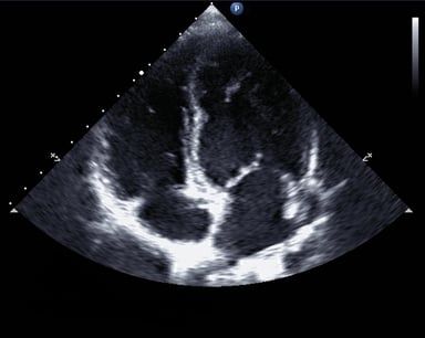 Echocardiogram