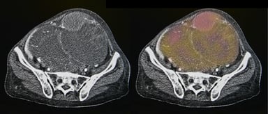 Ovarian cancer CT scan