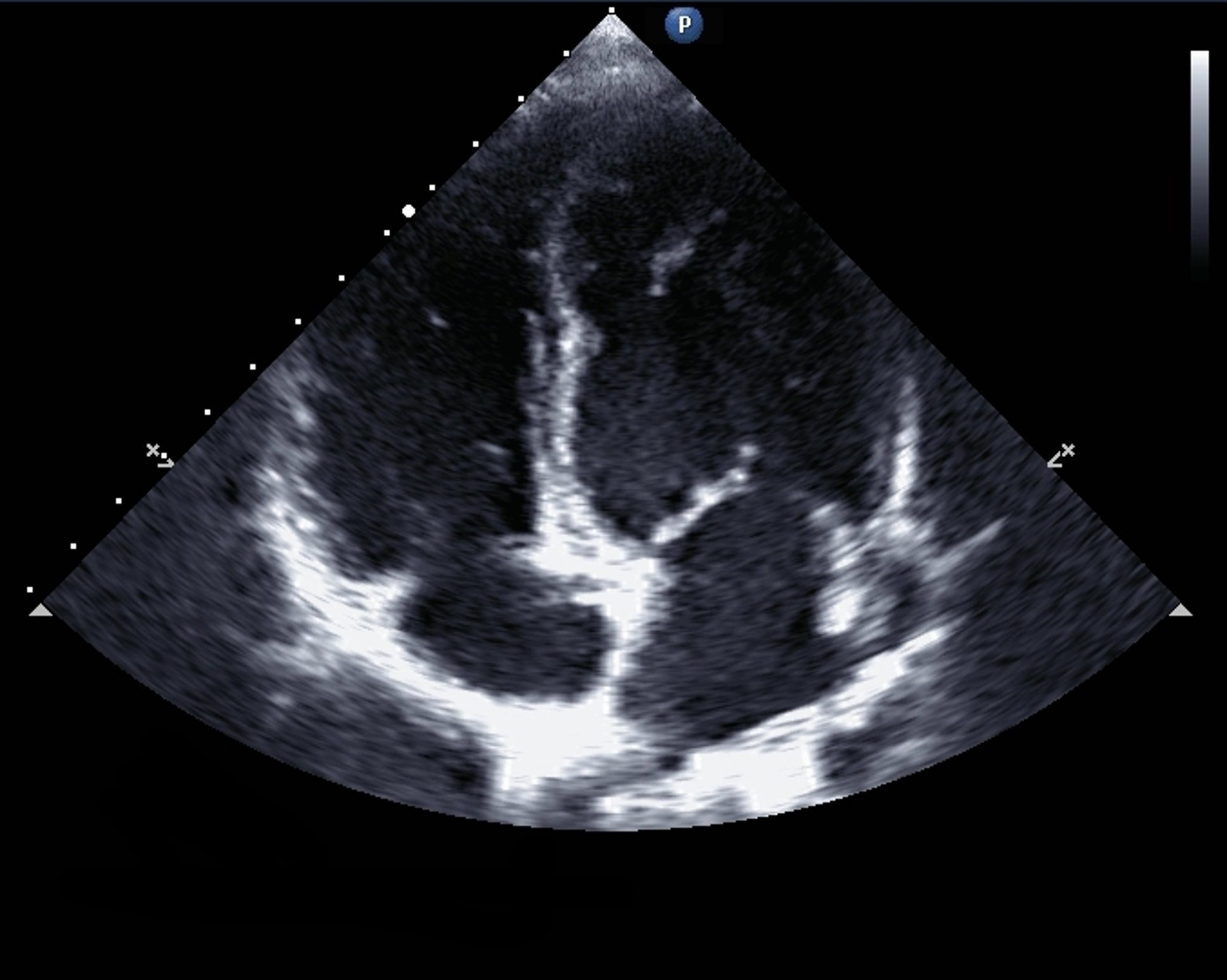 Echocardiogram 