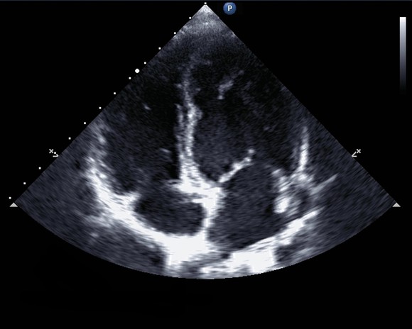 Echocardiogram 