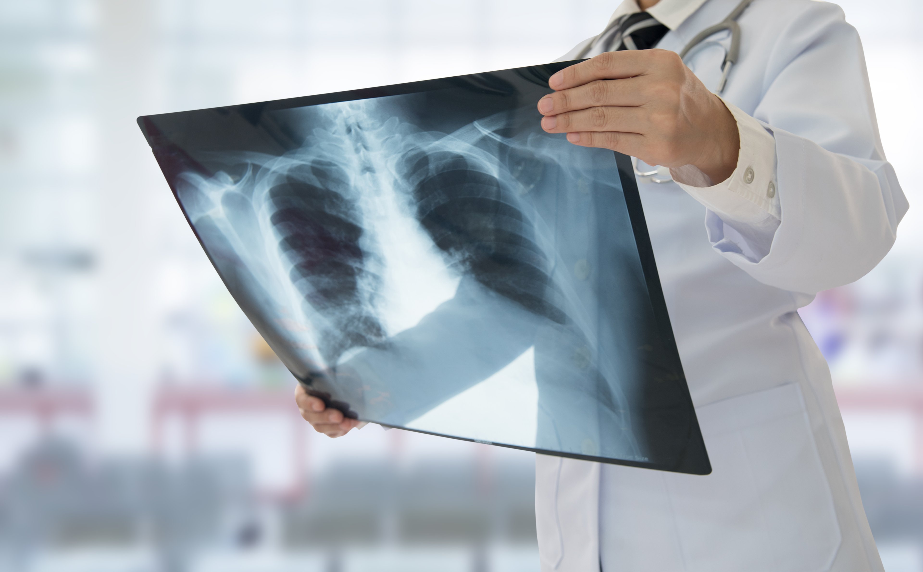 A physician holding an X-ray of lungs