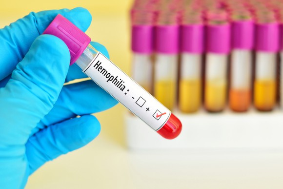 A vial of human blood labeled Hemophilia.