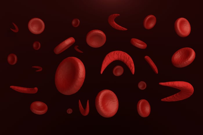 Sickled and normal red blood cells.