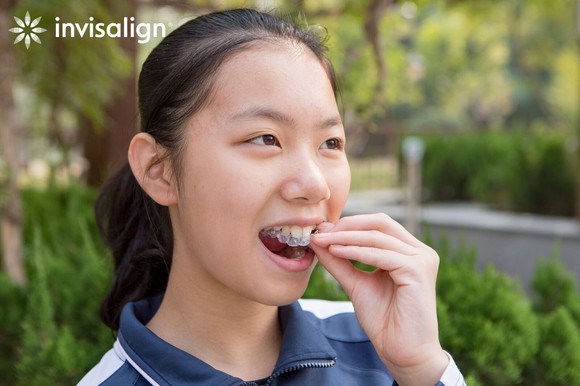 Young girl putting in an invisAlign liner