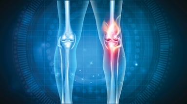 Knees, osteoarthritis