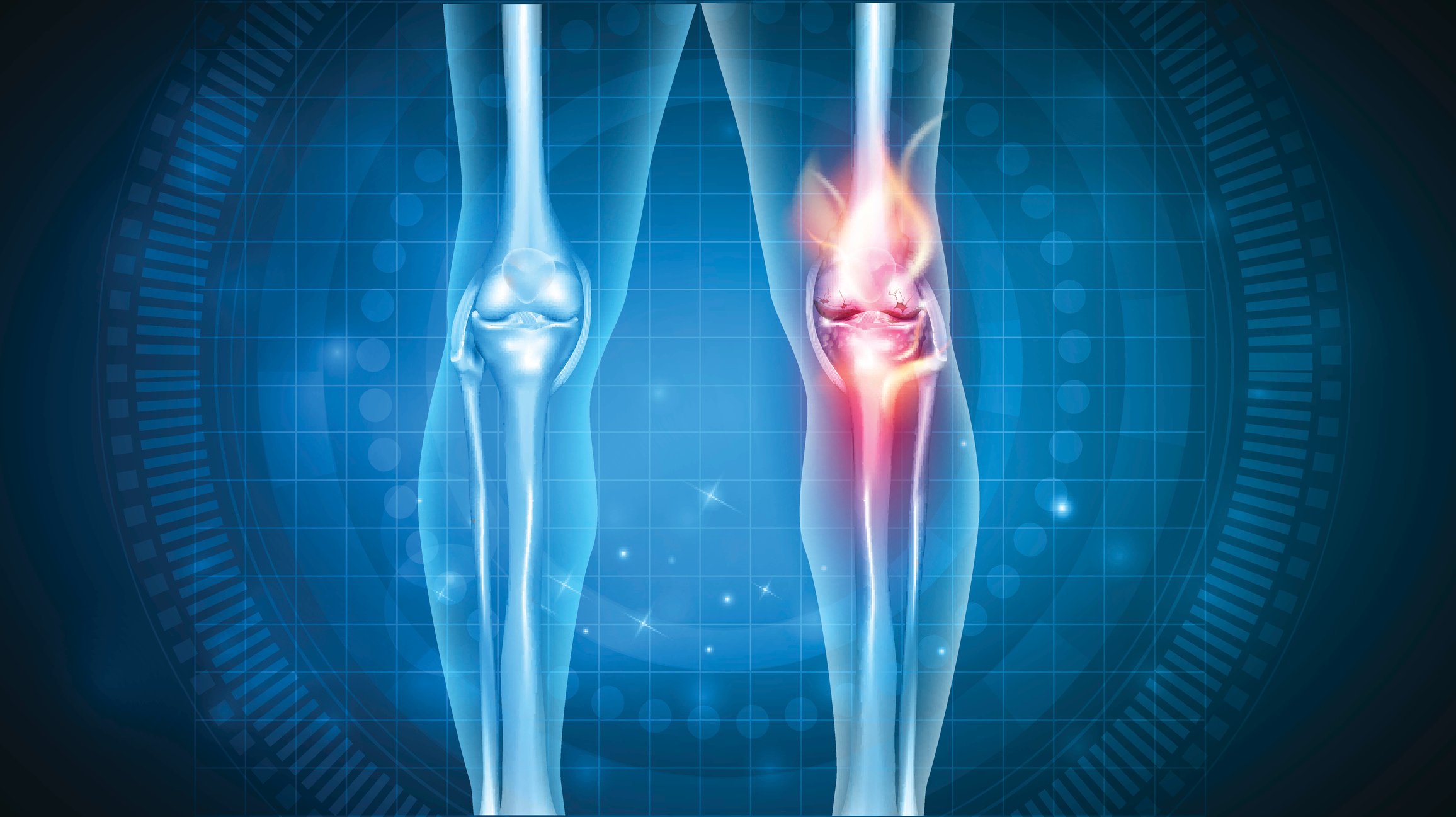 X-rays of knees with osteoarthritis inflammation in one knee