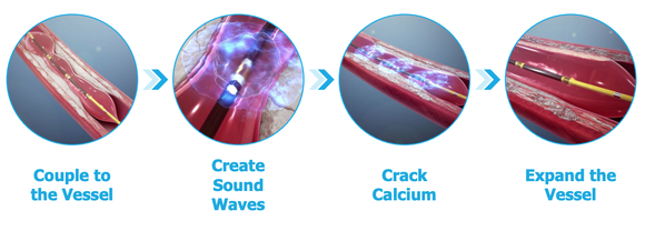 A graphic displaying the steps of inserting a ShockWave intravascular lithotripsy device and breaking calcium