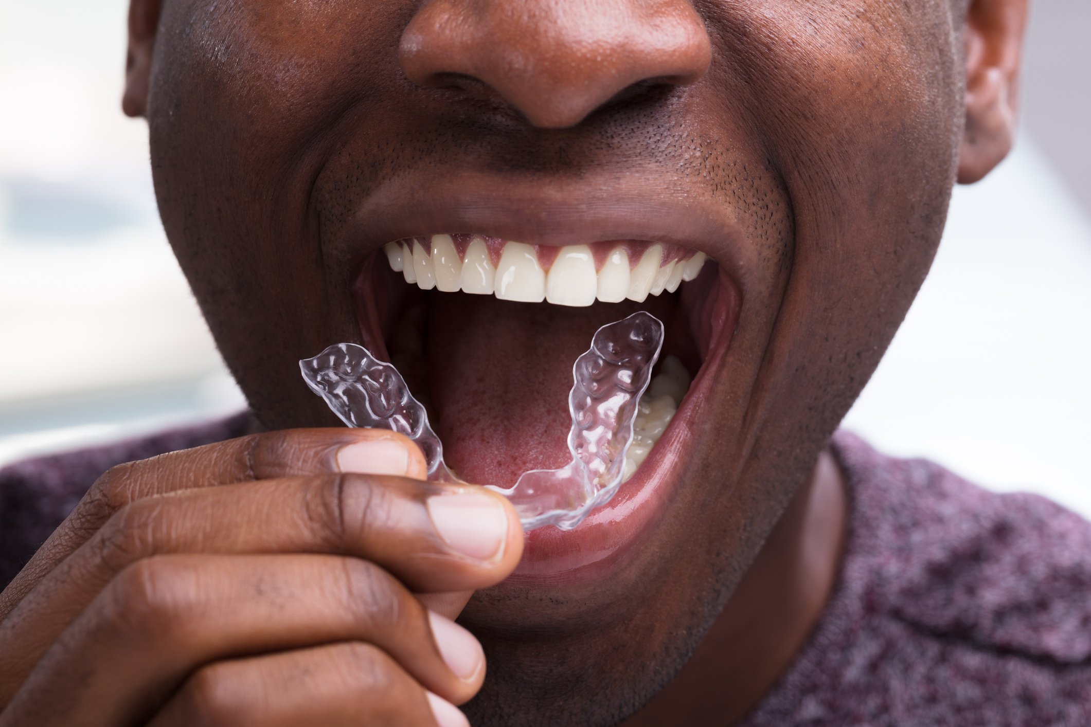 Man putting clear dental aligner into his mouth