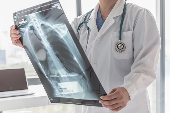 Medical professional holding an x-ray image of an ill patient's lungs.