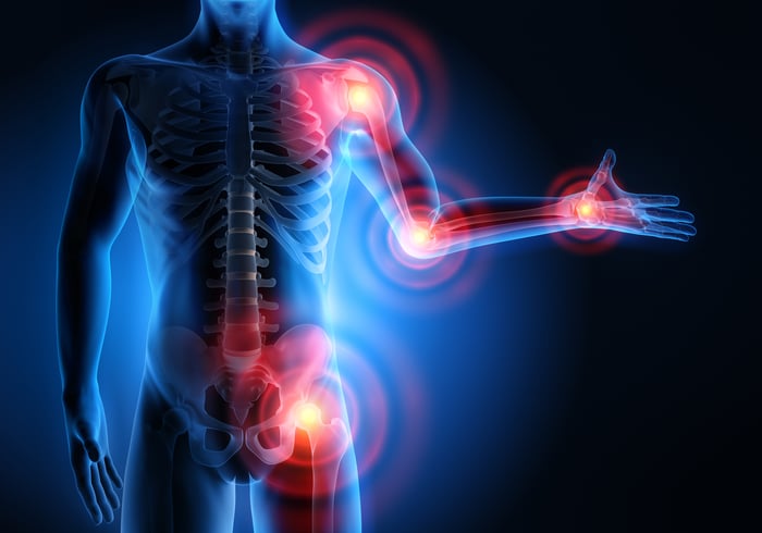 An X-ray-like illustration shows rheumatoid arthritis locations on body.