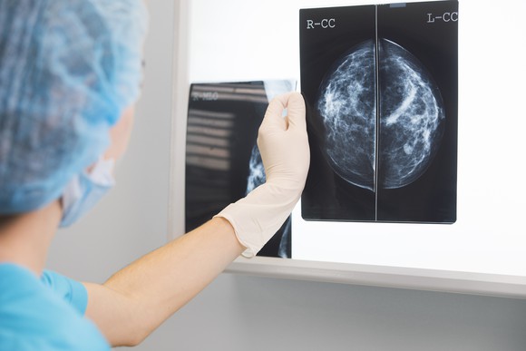 Medical professional holding a picture of a mammogram.