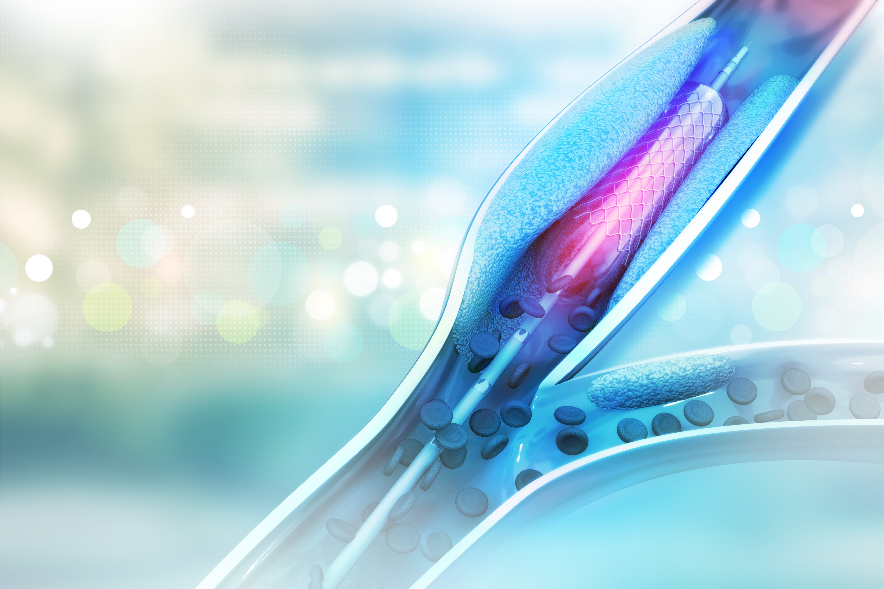 An angioplasty catheter inserted into a clogged artery.