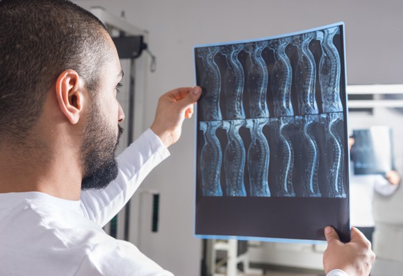 A doctor evaluating x rays of a spine.