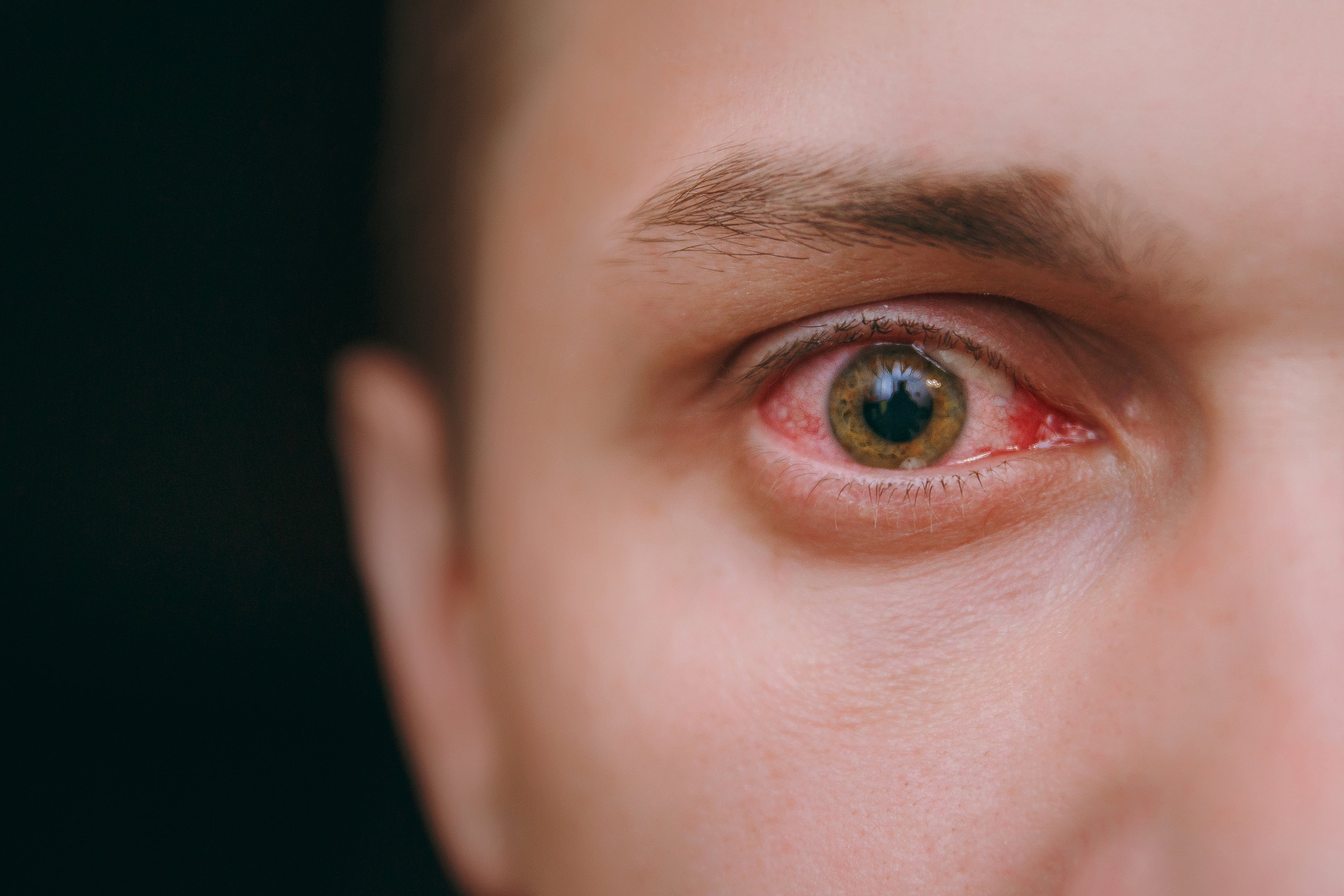 inflammation of eye