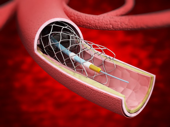 Depiction of a stent mesh being inserted inside an artery.