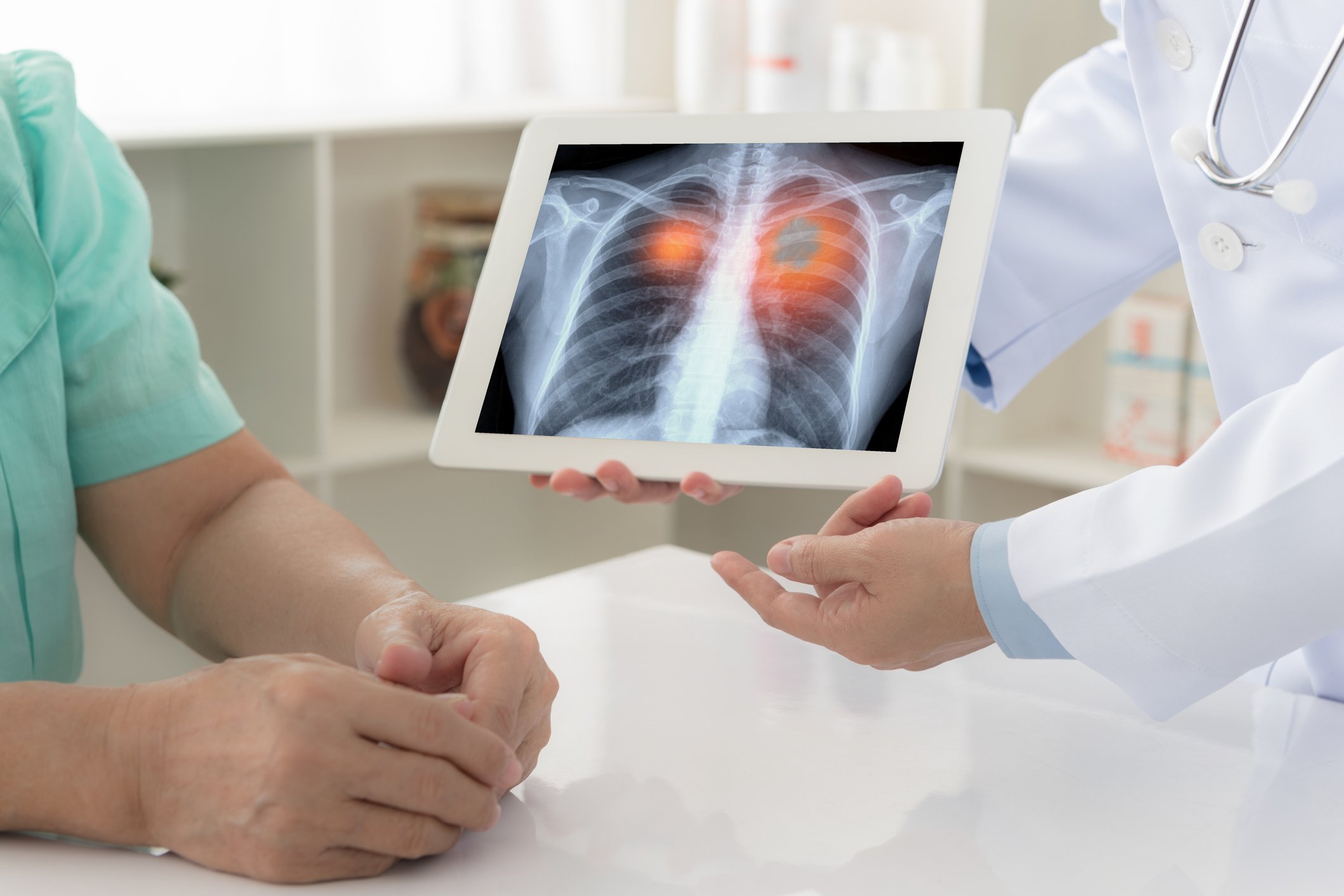 A doctor showing a patient a picture of an xray showing lung cancer.