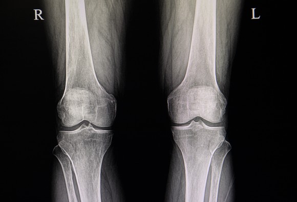 X-ray of knees
