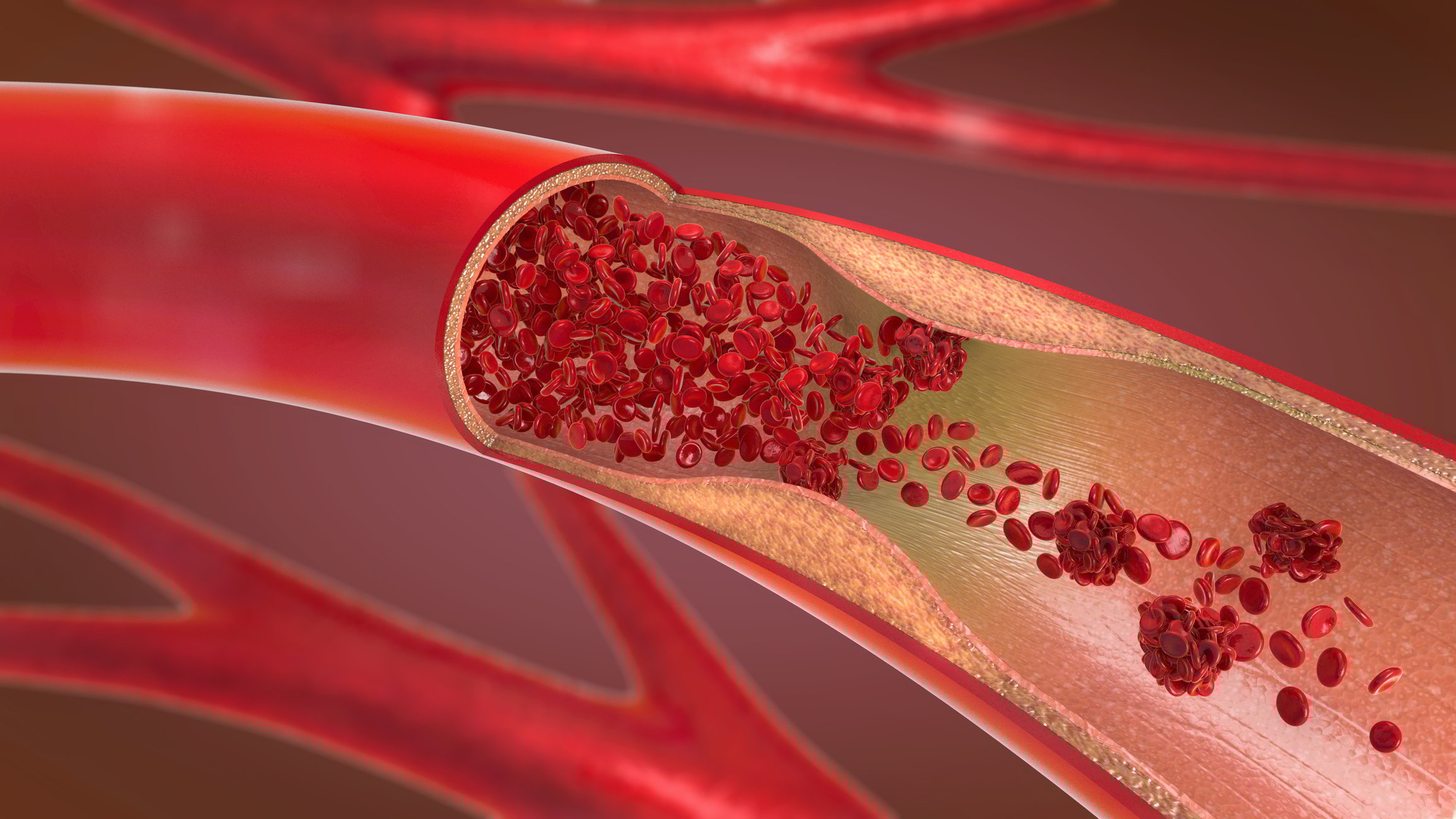 A picture of a blood vessel with plague slowing down the flow of red blood cells.