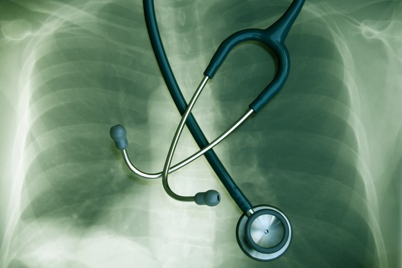 An X-ray of a person's lungs with a stethoscope placed on top. 