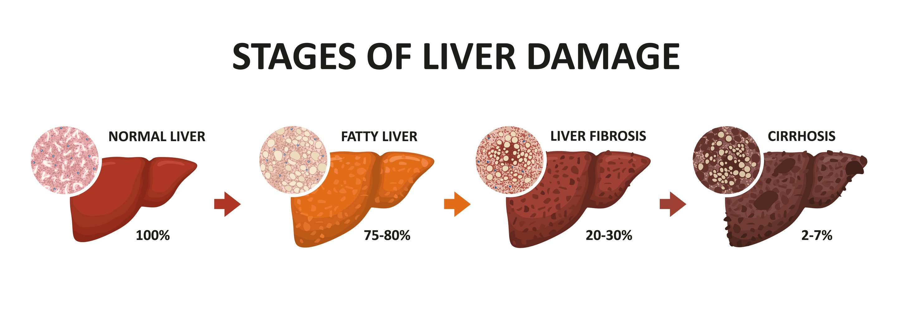 stages of liver disease