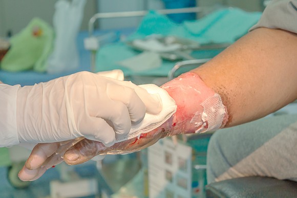 Burn treatment being administered on someone's hand.