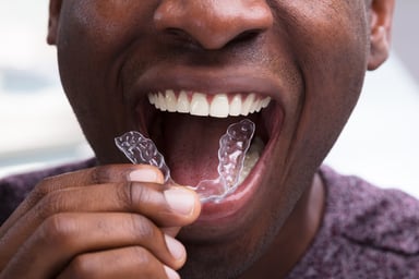 dental aligners