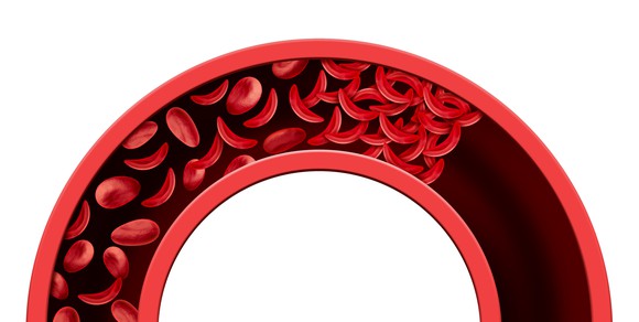 Sickle-shaped red bloods cells in a blood vessel.
