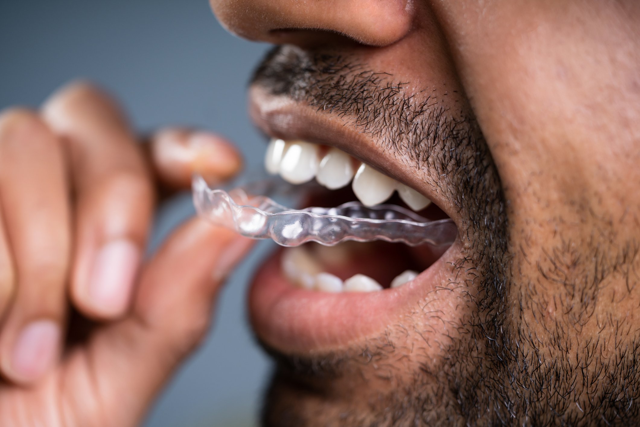 A man inserting an aligner into his mouth.